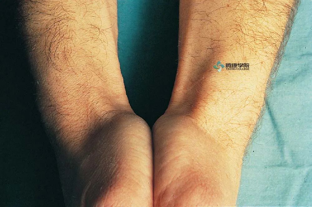 疼痛解剖学dequervain腱鞘炎finkelstein试验