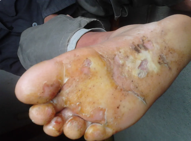 足癣大揭秘如何治疗和防止其复发