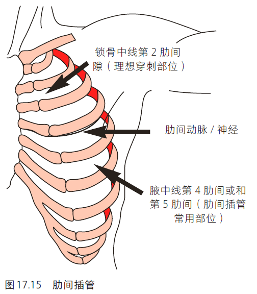 另外一个穿刺部位是腋中线上第4肋间隙或第5肋间隙,由于美容原因在