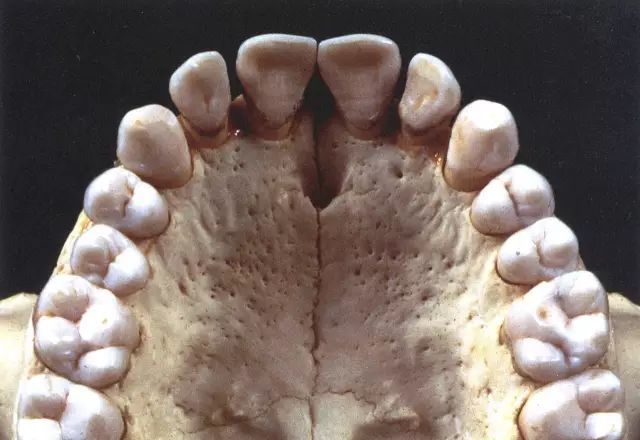 从中间开始切牙(2颗),犬齿(1颗),小臼齿(2颗),大臼齿(2颗),之后有可能