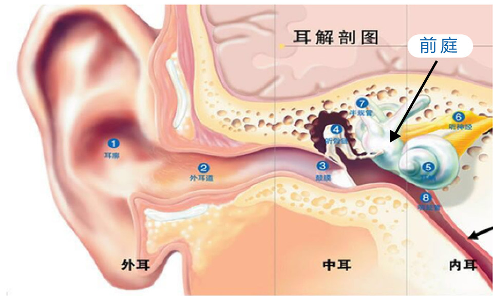 第三个常见病症是前庭性偏头疼,它一般表现为反复发作一过性眩晕和