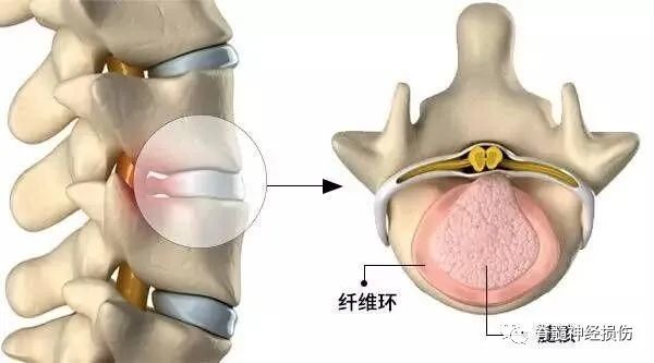 腰椎间盘突出压迫神经会很严重吗?