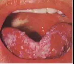 收藏61张高清舌诊图谱图文对照