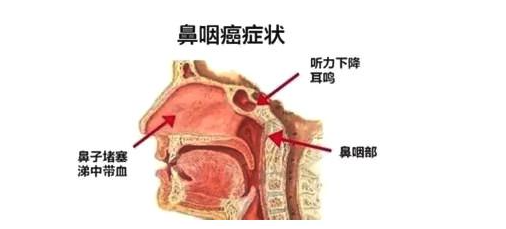 鼻咽癌的相关知识,早知道就是救命!