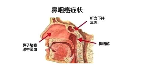 鼻咽癌早期的五大症状图片