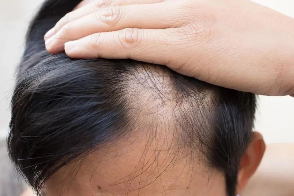 秃 如其来 一觉醒来头发竟缺一块 还有救吗 腾讯新闻