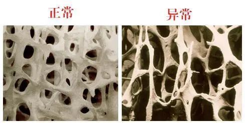 光靠吃钙片治不好骨质疏松这是因为啥