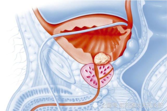 前列腺增生詳解前列腺增生是怎麼引發的有什麼表現如何預防和治療
