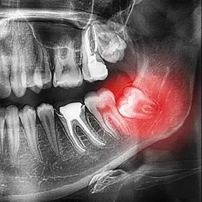 第三磨牙|併發症|智齒|拔牙