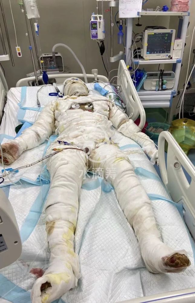 普宁云落519车祸续货车驾驶员全身烧伤面积约93