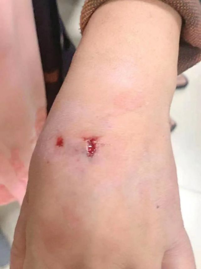 南通一地惊现疯狗,已咬伤20余人,疯狗可能仍在游荡!