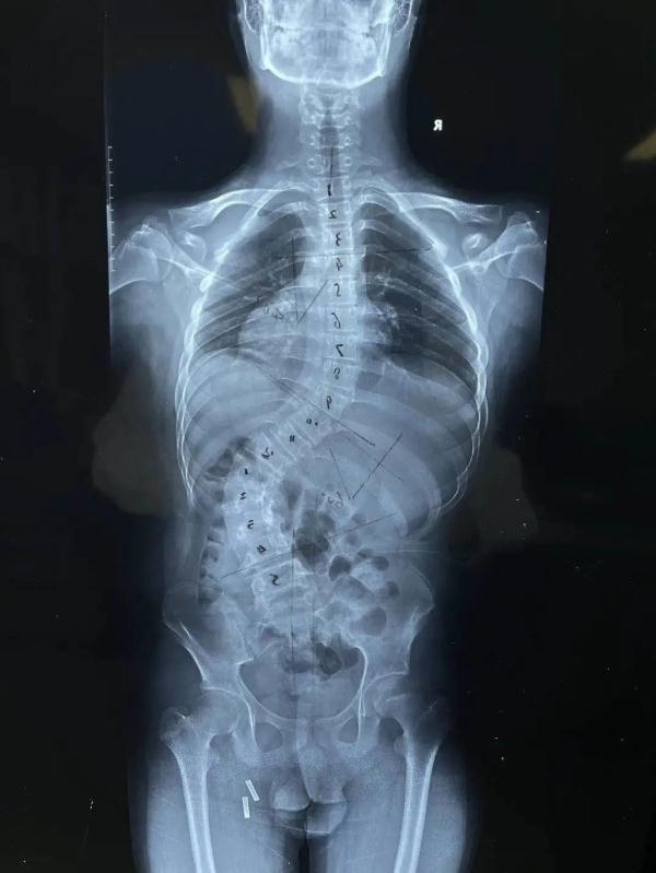15岁男孩脊柱侧弯达60度!医生提醒,孩子出现此类情况需当心!