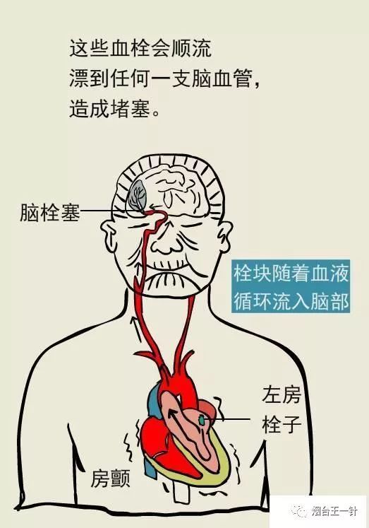 什么是脑中风