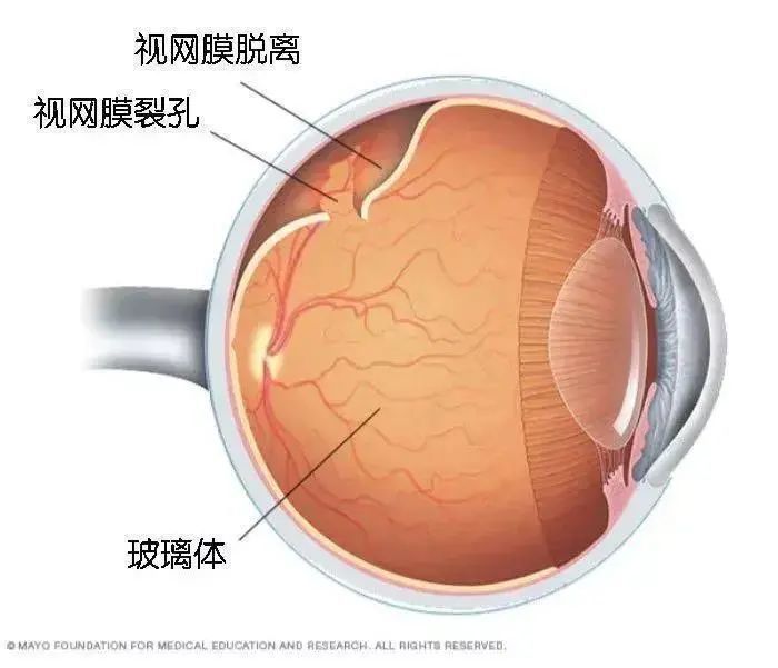 高度近视的五大并发症之一视网膜脱落