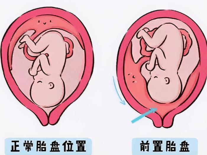 懷孕後是胎盤前壁好還是後壁好,你怎麼看?