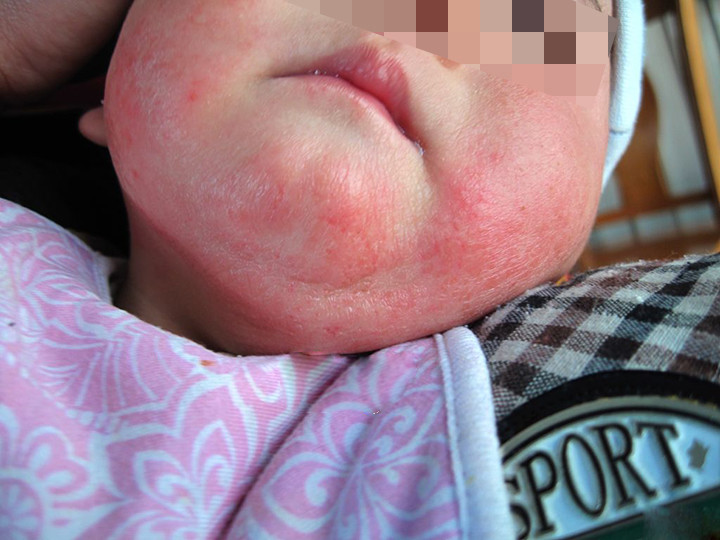 4个月宝宝长湿疹新手妈妈急病乱投医导致湿疹越来越严重