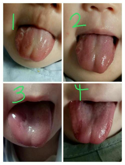 小孩舌头有白点图片图片