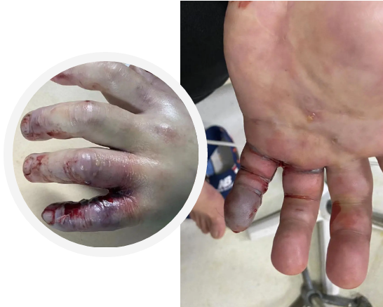 广西一男子被海鱼扎破手因此截肢,罪魁祸首是……_腾讯新闻