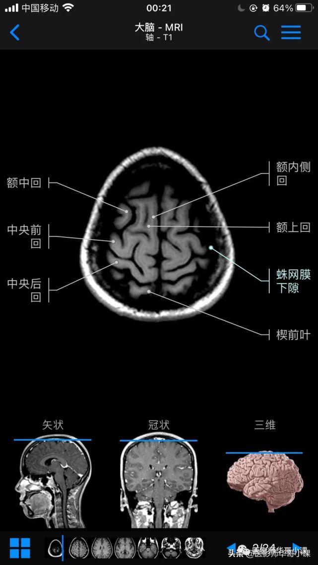 写给小白 关于体检中核磁共振mri 科普 知乎