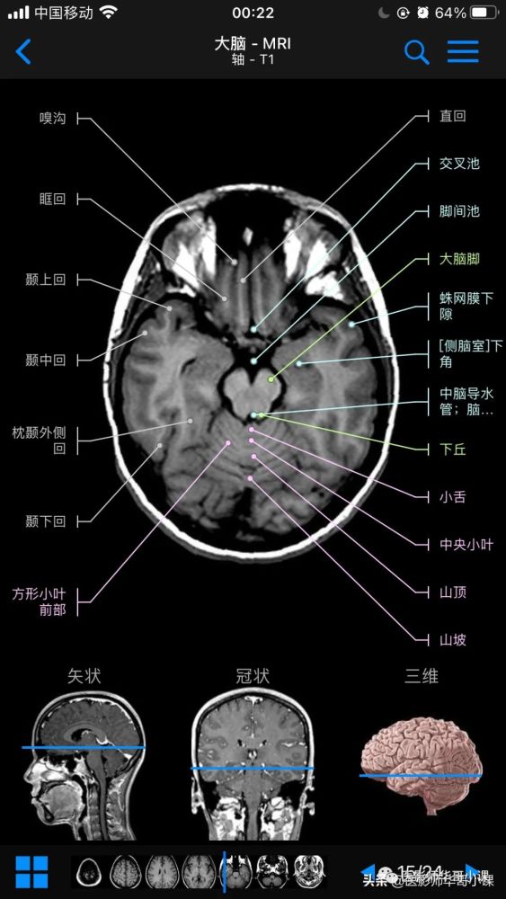 高清mri圖顱腦磁共振mri解剖