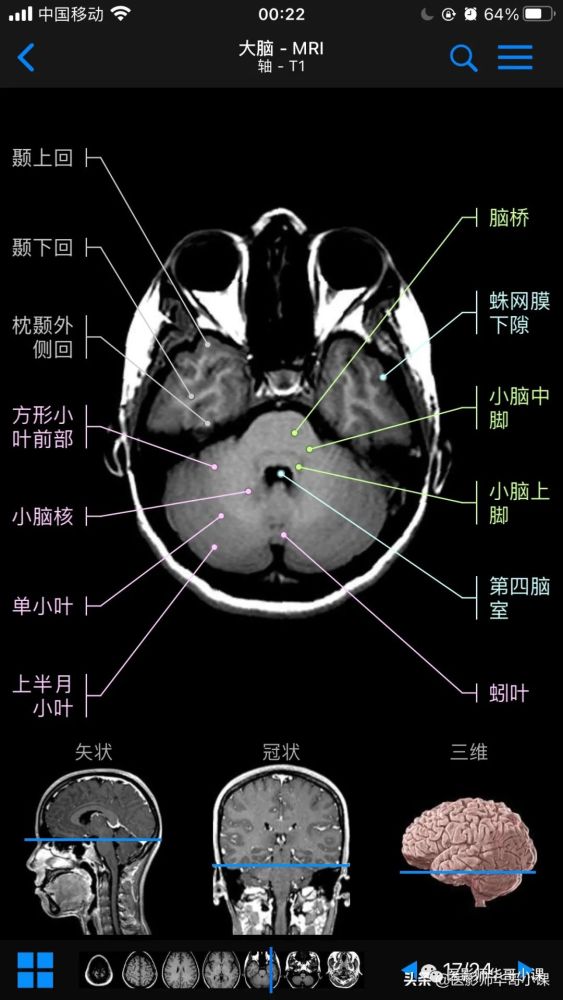 高清mri圖顱腦磁共振mri解剖