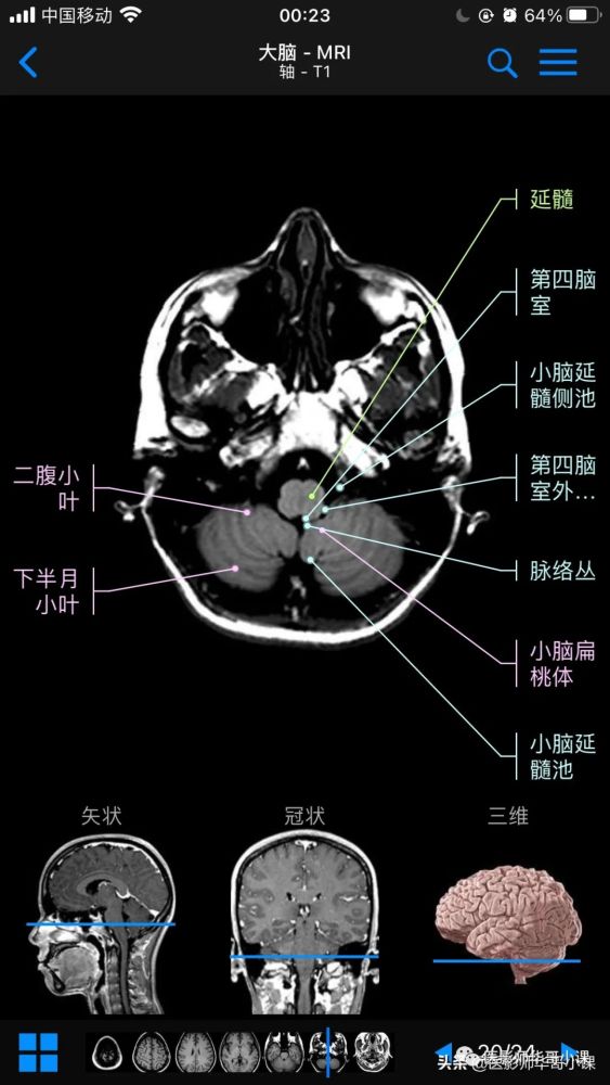 高清mri图颅脑磁共振mri解剖
