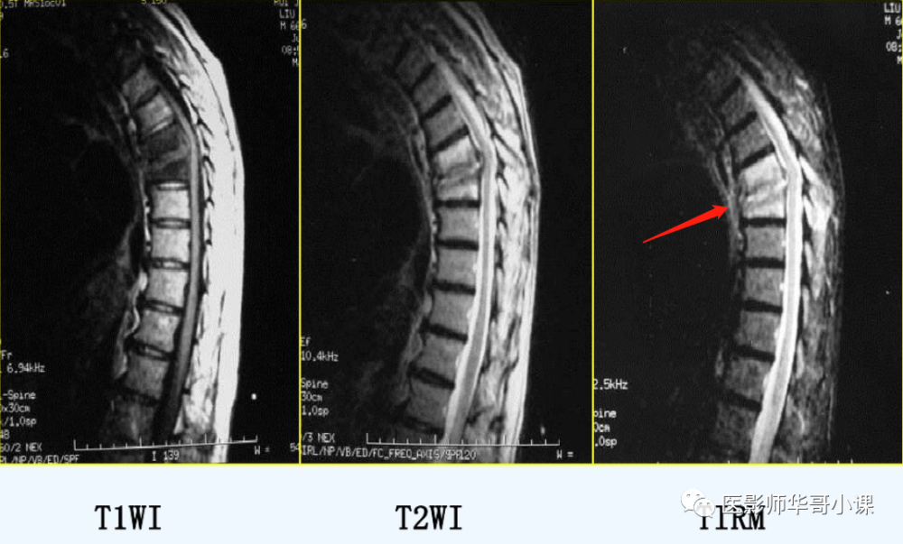 高清mri圖脊柱磁共振mri解剖
