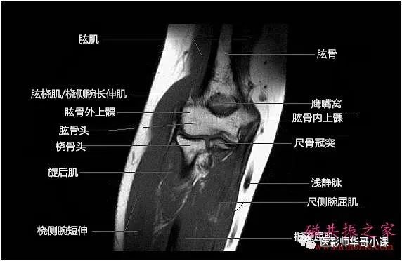 高清mri圖肘關節磁共振mri解剖