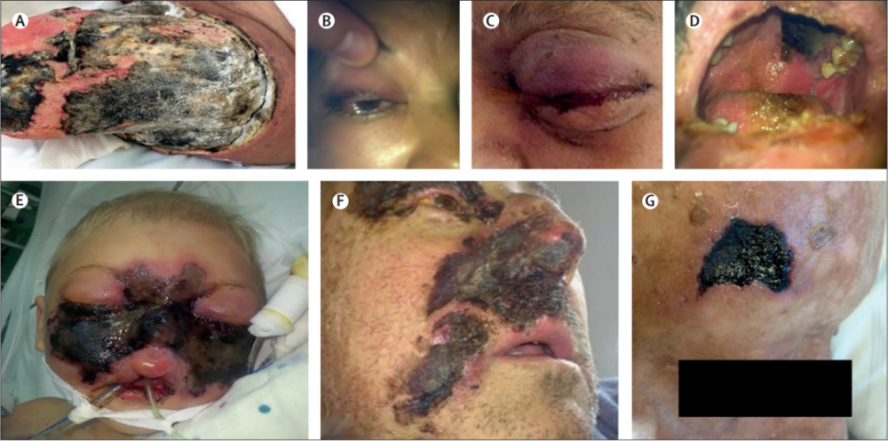 活人发霉印度肆虐的毛霉菌病到底有多恐怖