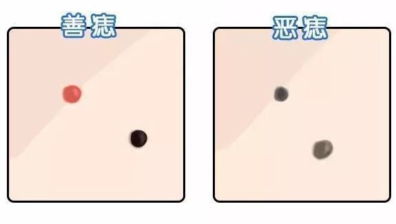 痣相看命运:手臂这处有痣的人,命中财运好,富贵双全家业旺