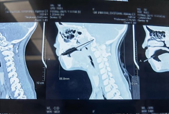 筷子扎伤喉咙照片图片