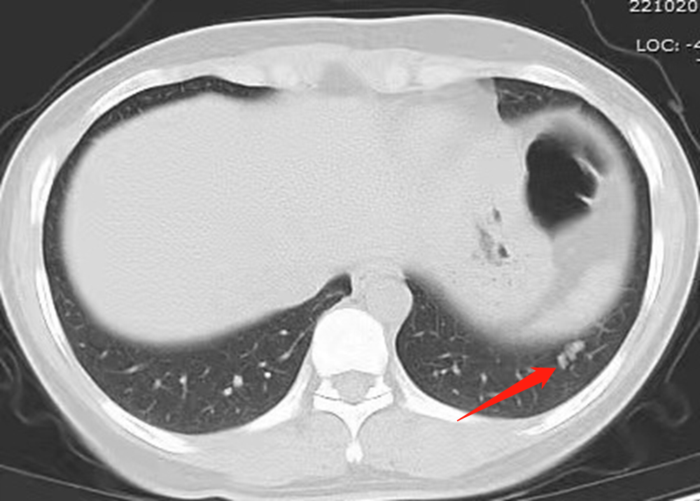 脑卒中病因竟在肺 常德一医超高端螺旋ct血管成像技术助力临床诊断