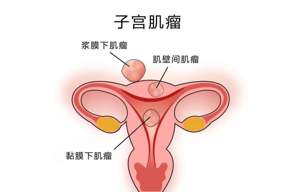 患子宫肌瘤这些食物再喜欢也不能吃子宫肌瘤体检需按这个标准