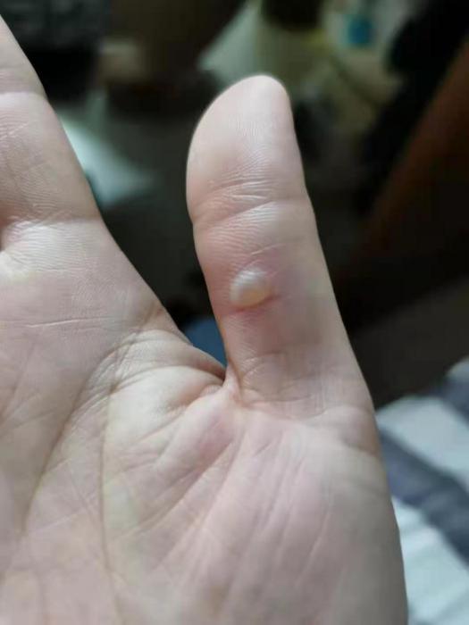 护士1天打822针手磨起泡,祈福医院紧急提醒:打疫苗须先预约_腾讯新闻