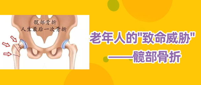 老年人的致命威胁髋部骨折