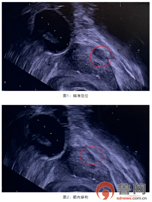 零盲区丨经会阴前列腺靶向穿刺帮助患者确诊早期前列腺癌