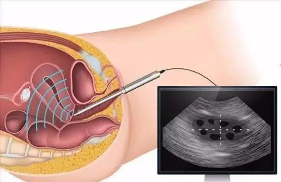 为什么要做阴道超声检查?痛不痛?