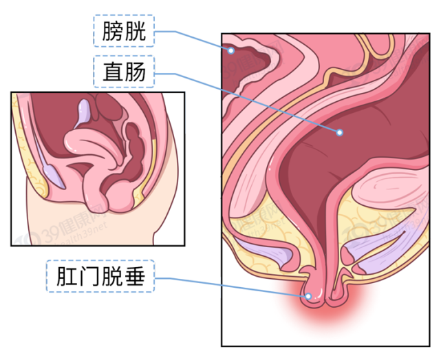 2,直腸脫垂:肛門括約肌無力,直腸全層或部分黏膜脫出肛門外,直腸粘膜