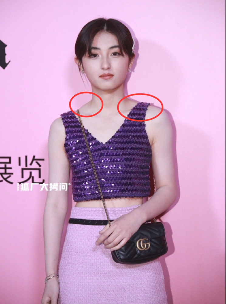 张子枫肩颈一夜回到解放前,直角肩仅维持2年,变美之路太艰难!