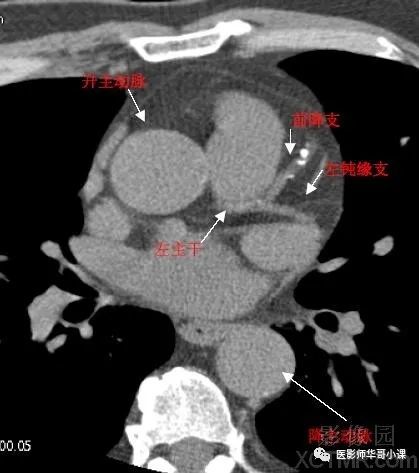 【高清ct图】心脏冠脉cta解剖