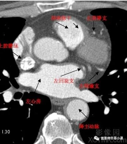 【高清ct圖】心臟冠脈cta解剖