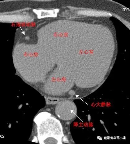 冠脉cta是一种微创的冠状动脉血管检查手段,一般对身体没有大的伤害.