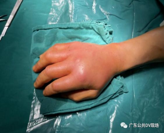 被水桶刮伤,男子手部肿胀发紫险截肢!_腾讯新闻