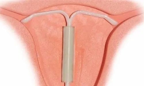 适合哪种节育听环医生告诉你