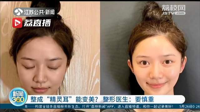 网红称整成"精灵耳"可变美 提醒:将正常耳朵整成畸形 这种手术正规