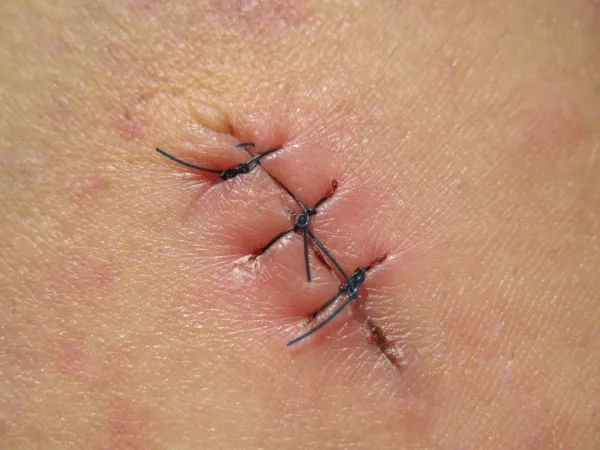 据了解,外科缝合的方法有多种,像小伟那样的缝合处理属于单纯间断缝合