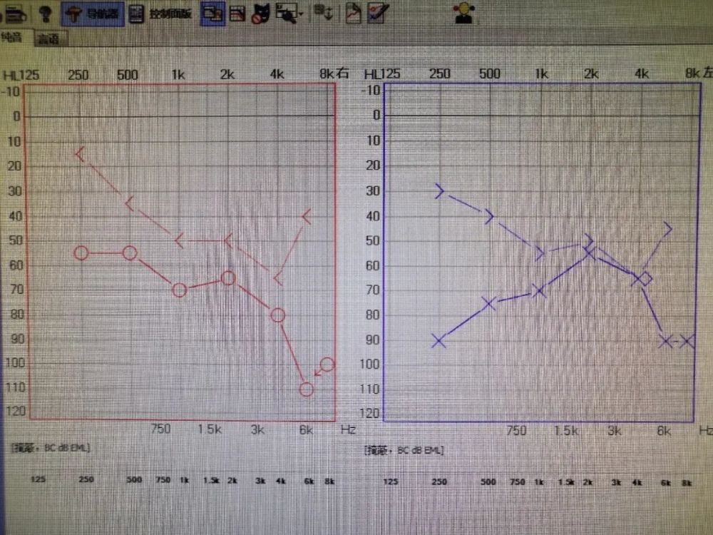 突发性耳聋不容忽视切记早发现早治疗