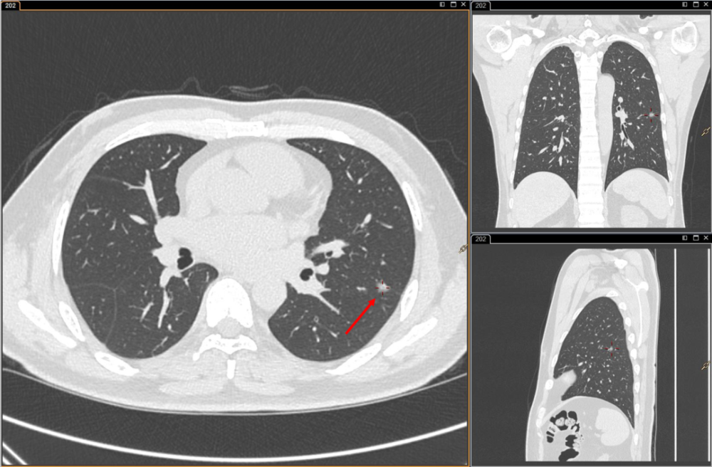 右肺上葉尖段磨玻璃結節1,磨玻璃結節(gross glass nodule, ggn):在ct