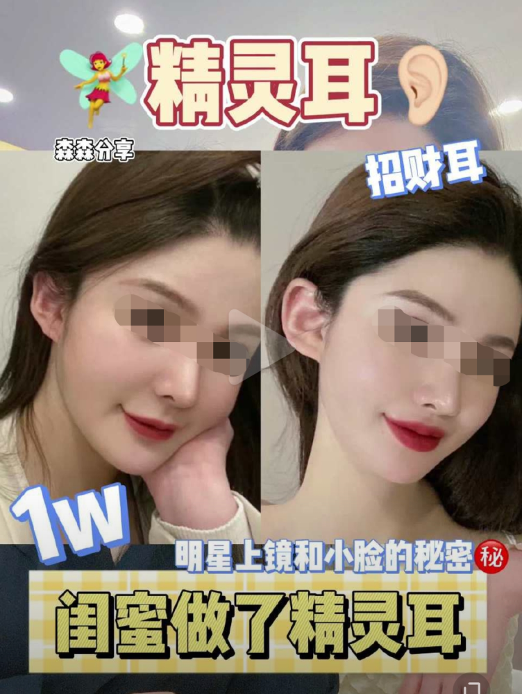 这位博主非常开心地展示着打了玻尿酸的耳朵,并声称"精灵耳"的效果使