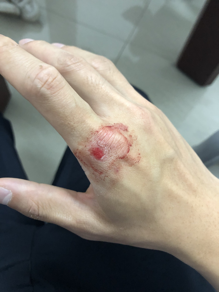 民警受伤的手事后,郭茂华才发现自己全身被汗浸湿,手擦伤流血